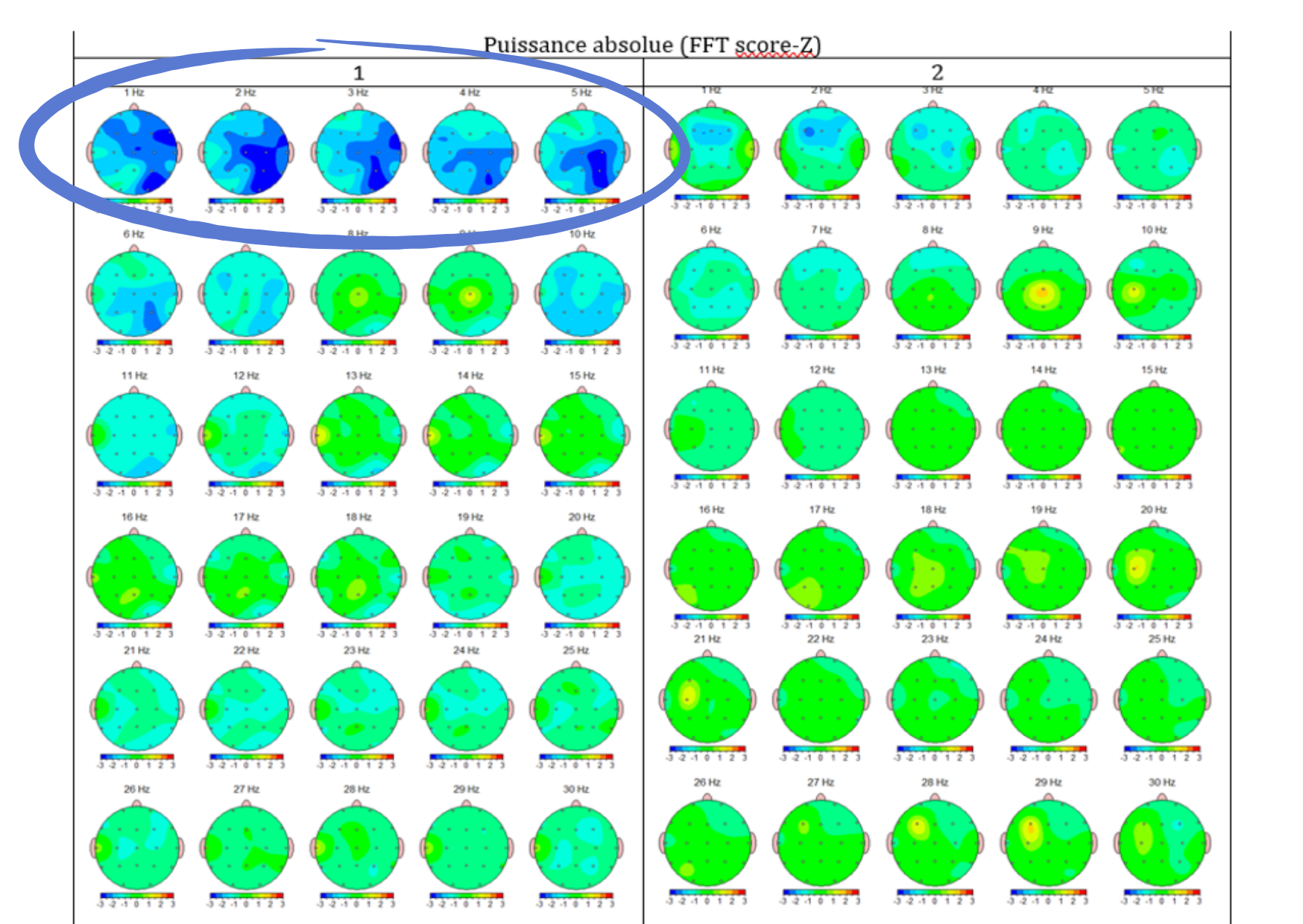 Cartographies d'un bilan EEGq avant et après l'entraînement : le déficit d'activité lente visible au bilan initial s'est normalisé