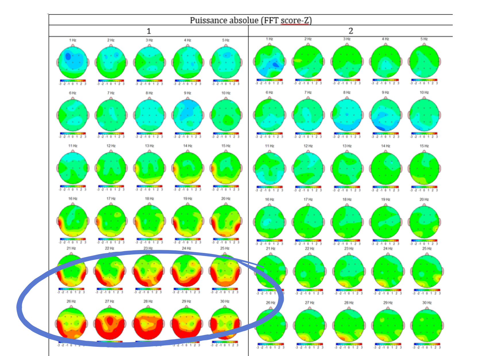 Cartographies EEGq en Z-scores de 1 à 30 Hz, avant et après un entraînement en neurofeedback guidé par EEG quantifié : l’excès d’activité rapide visible au bilan initial s’est normalisé au bilan de suivi