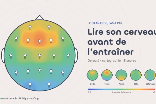 Illustration d’une cartographie EEGq : tête vue de dessus avec les 19 électrodes du système 10-20 et les écarts à la norme en couleurs
